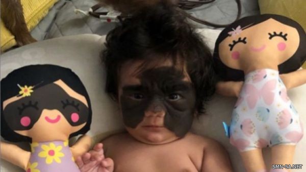 "لونا" طفلة أمريكية تتعرض للتنمر بسبب وحمة تغطي وجهها ..!