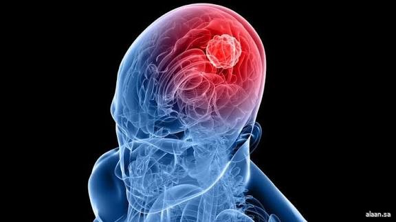 تطوير طريقة علاجية مبتكرة للورم الأرومي الدبقي