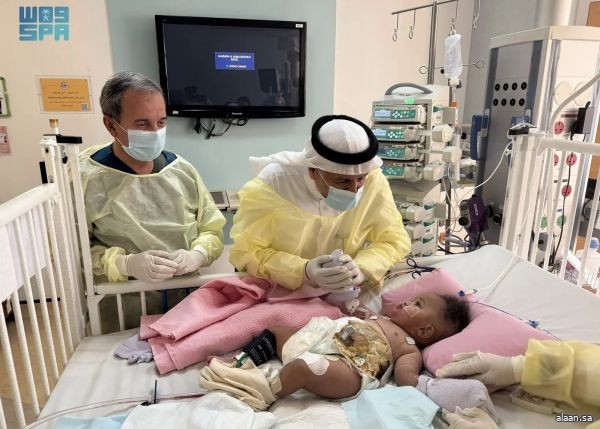 د. الربيعة: استقرار حالة التوأم الصومالي "رحمة ورملا" بعد مرور أربعة أيام من عملية فصلهما الناجحة